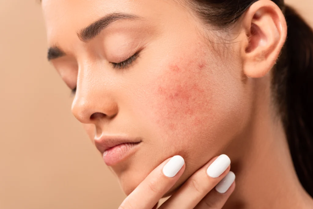 Close-up of a woman's cheek showing redness and inflammation, highlighting acne treatment needs.