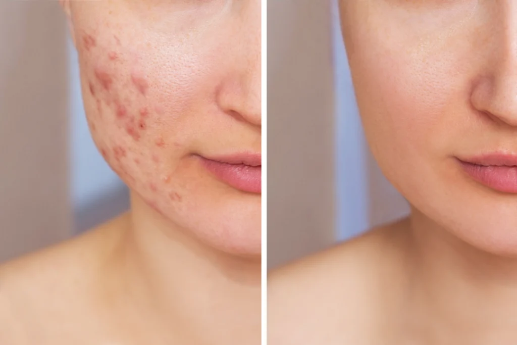 Before-and-after comparison of a woman's cheek showing acne treatment results.