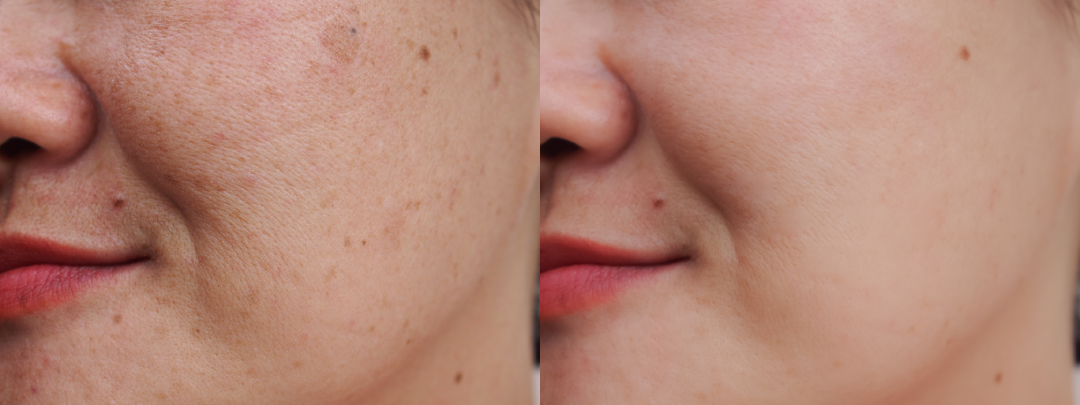 BBL before and after showcasing skin clarity.