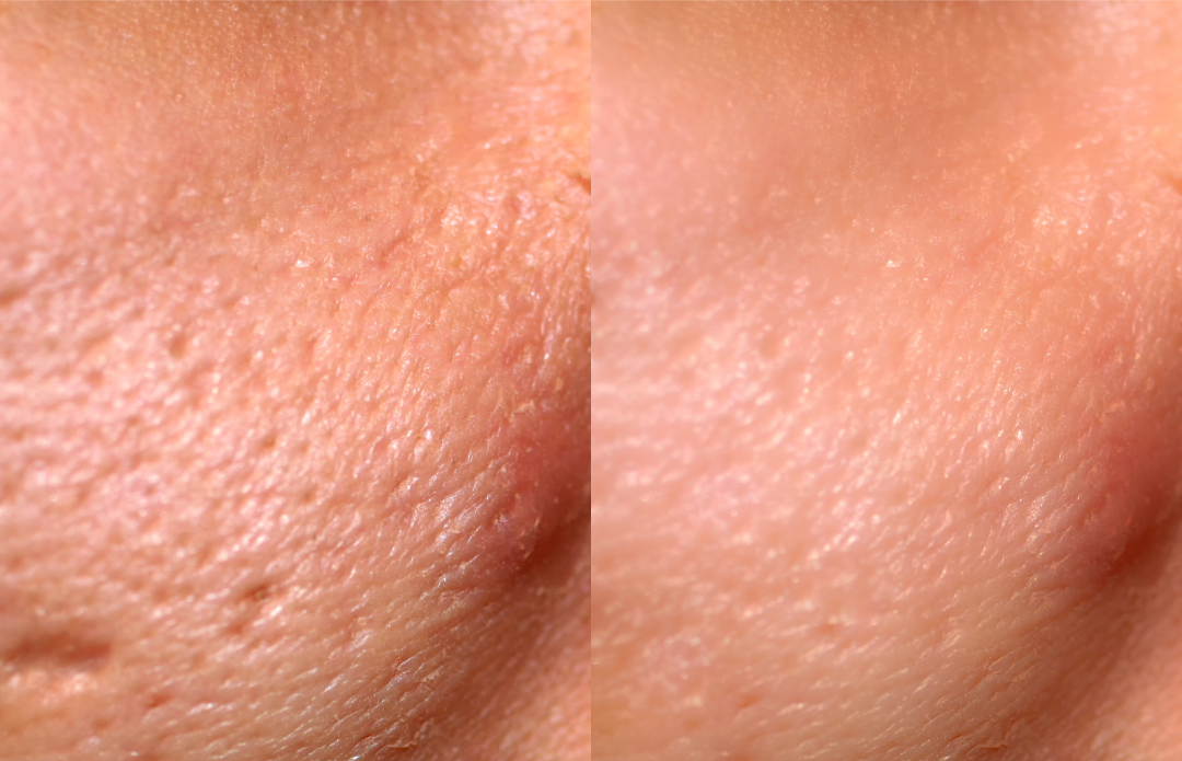 Close-up before and after results of laser skin resurfacing, showing smoother skin texture and reduced acne scars.