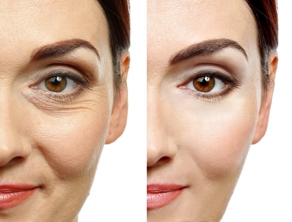 Woman’s face showing Botox before and after wrinkle reduction.