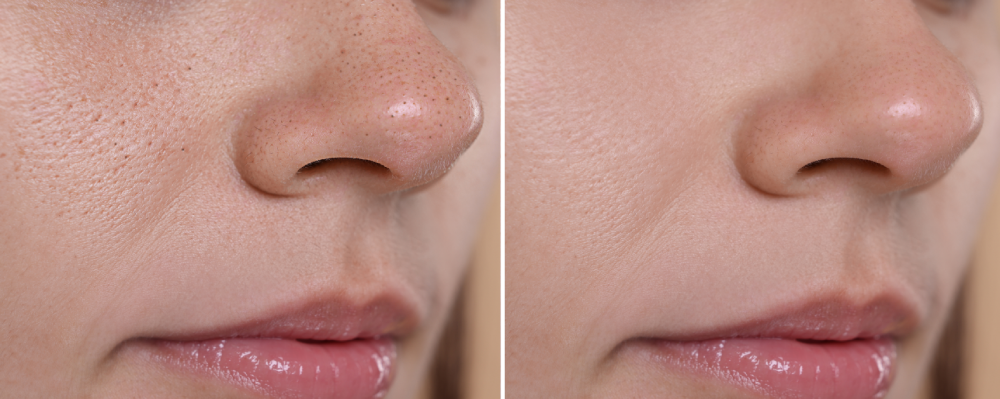 Close-up before and after results of DiamondGlow Facial.